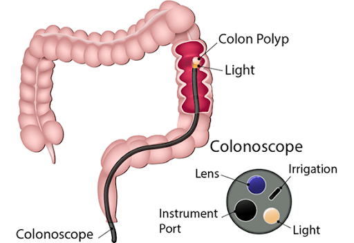 sigmoidoscopy