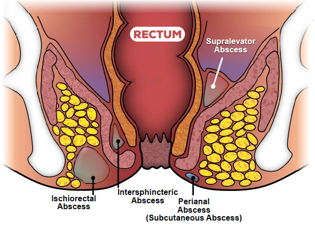 types-of-perianal-abscess​