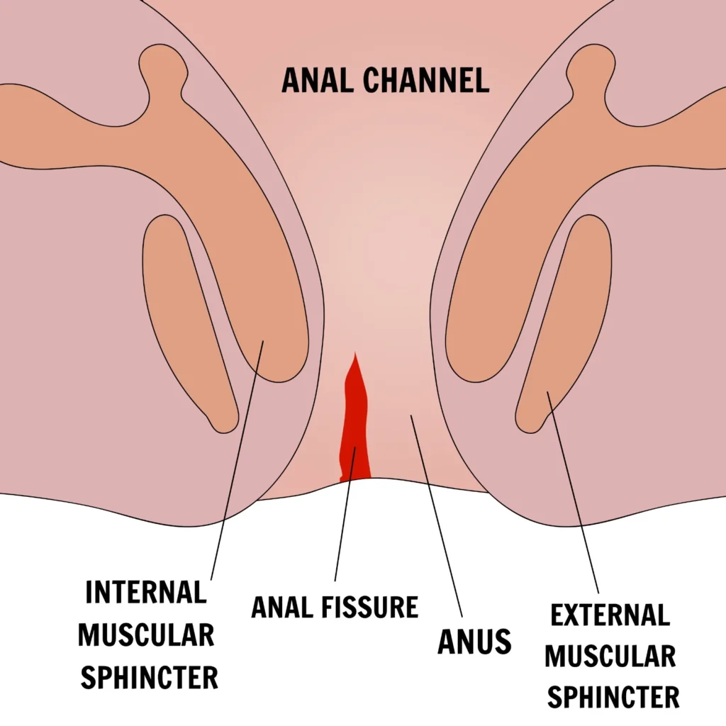 analfissure