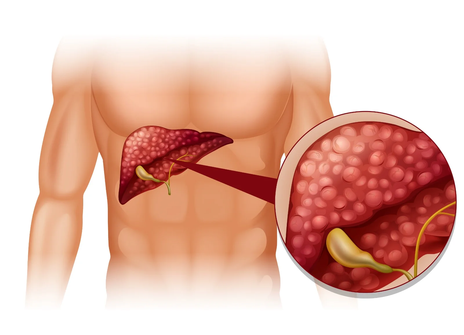 gallstones