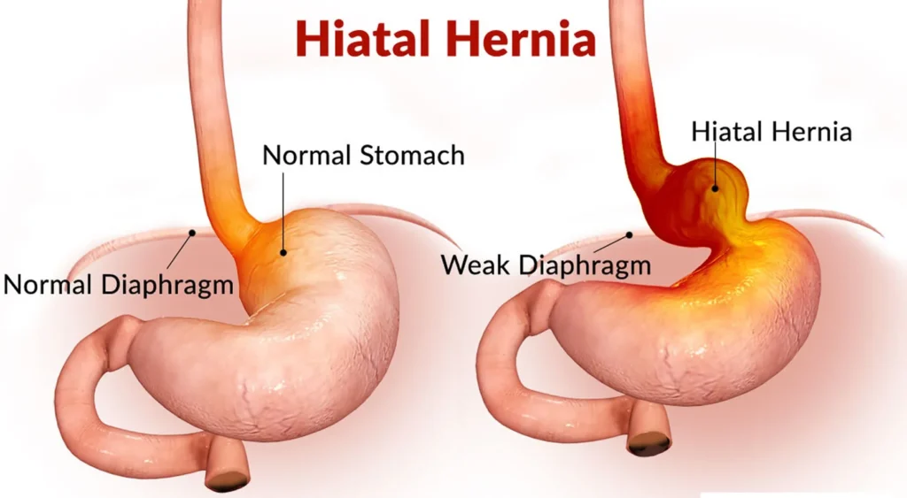 hiatal-hernia