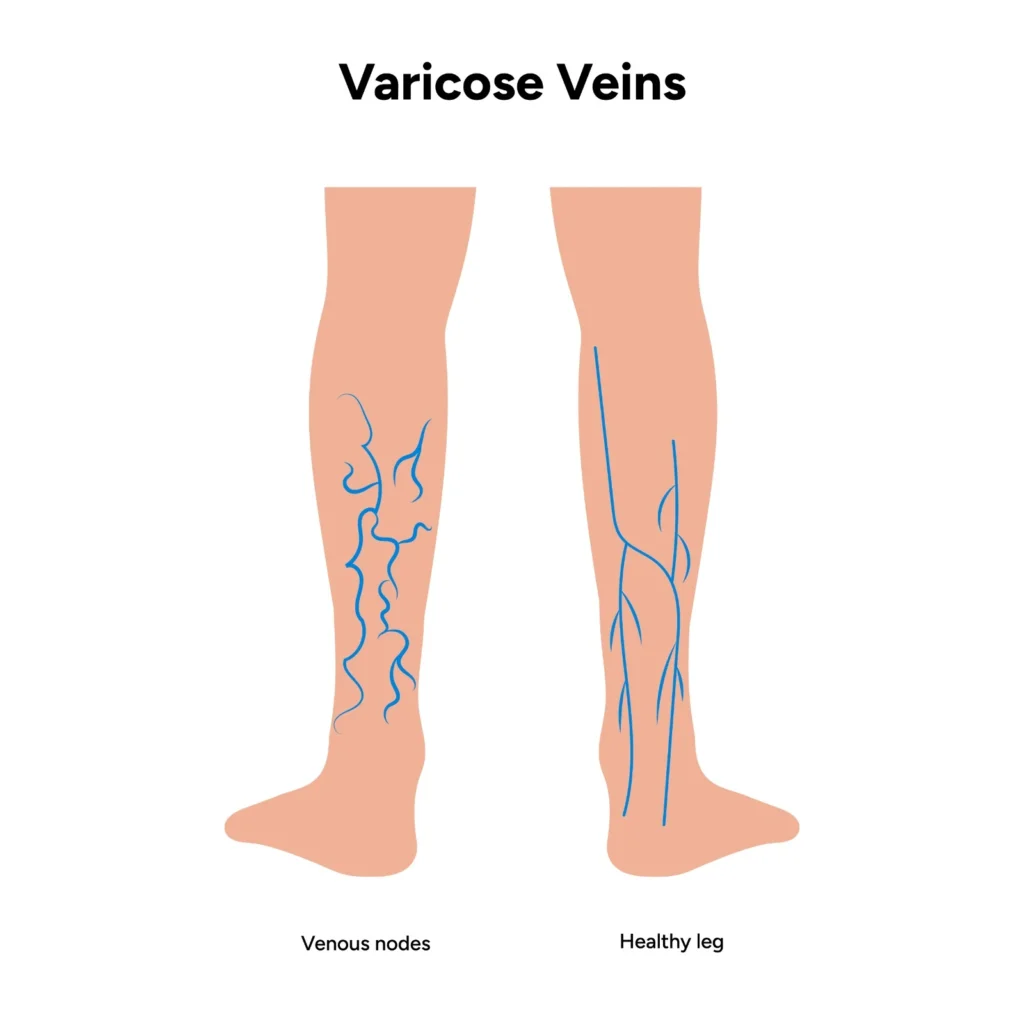 varicoseveins-1