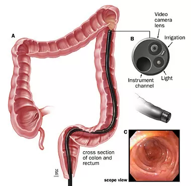 Sigmoidoscopy-performed
