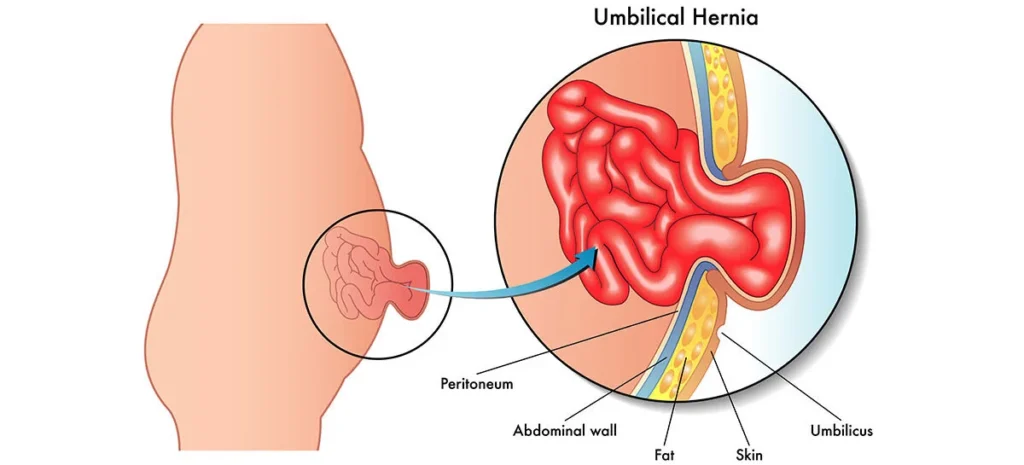 Umbilical-Hernia