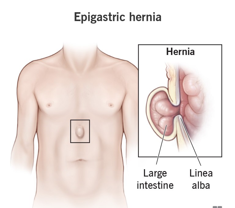 epigastric-hernia