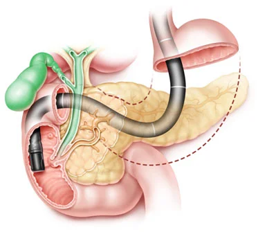 ercp-treatment
