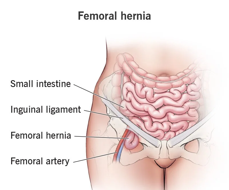 femoral-hernia