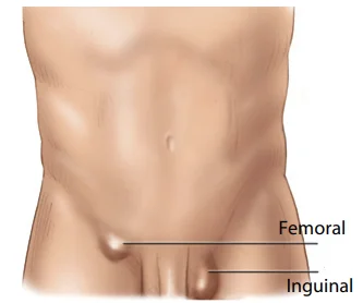 femoralhernia-1