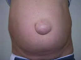 umblical-hernia