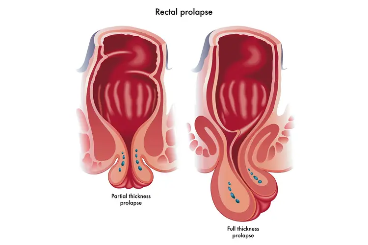 rectalprolapse2